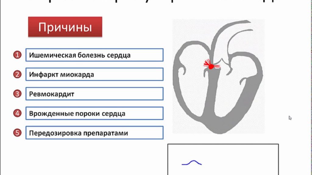 Блокада сердца: причины, симптомы и современные методы лечения