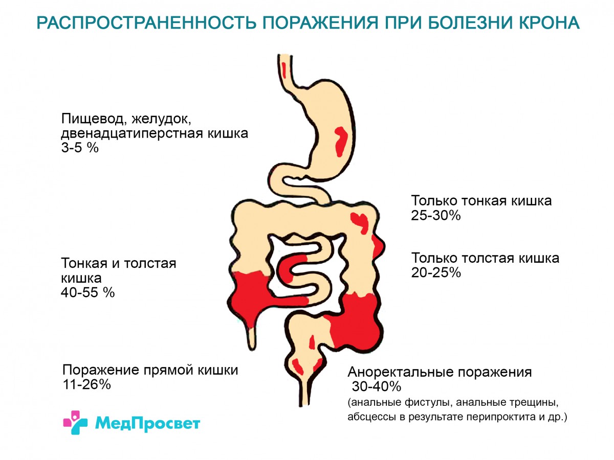 Болезнь Крона у детей: симптомы, диагностика и современные методы лечения