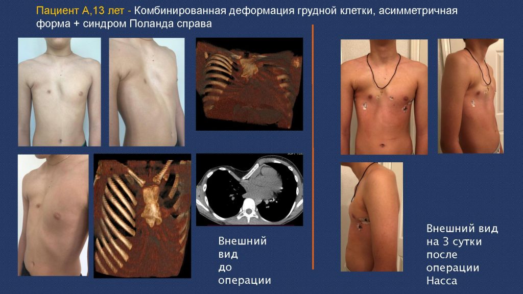 Деформация грудной клетки у подростка: причины, последствия и методы лечения