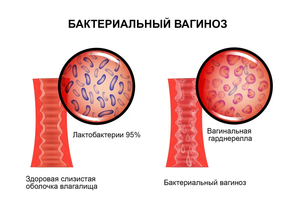 Диагноз 94.8 в гинекологии: что он означает и как интерпретировать результаты?