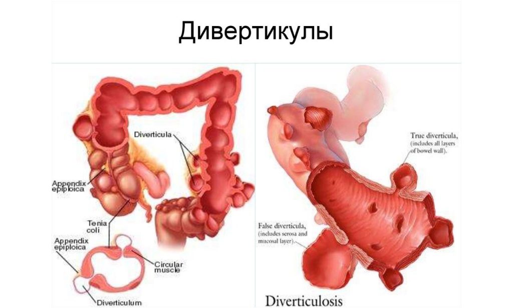 Дивертикул Меккеля: причины, симптомы и методы лечения