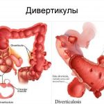 Дивертикул Меккеля: причины, симптомы и методы лечения