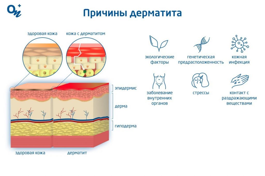 Эффективные методы лечения аллергического дерматита у детей: советы для родителей