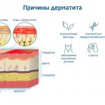 Эффективные методы лечения аллергического дерматита у детей: советы для родителей