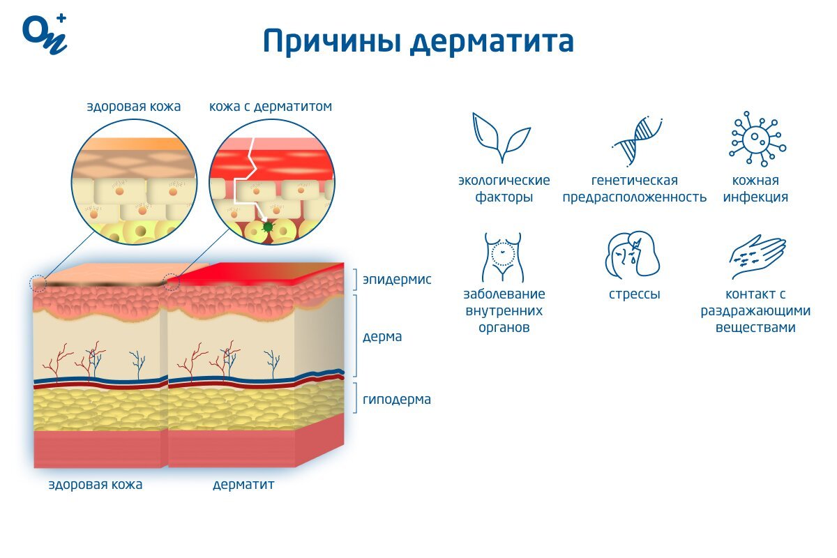 Эффективные методы лечения аллергического дерматита у детей: советы для родителей