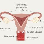 Эффективные методы лечения кандидозного вульвовагинита: советы и рекомендации специалистов