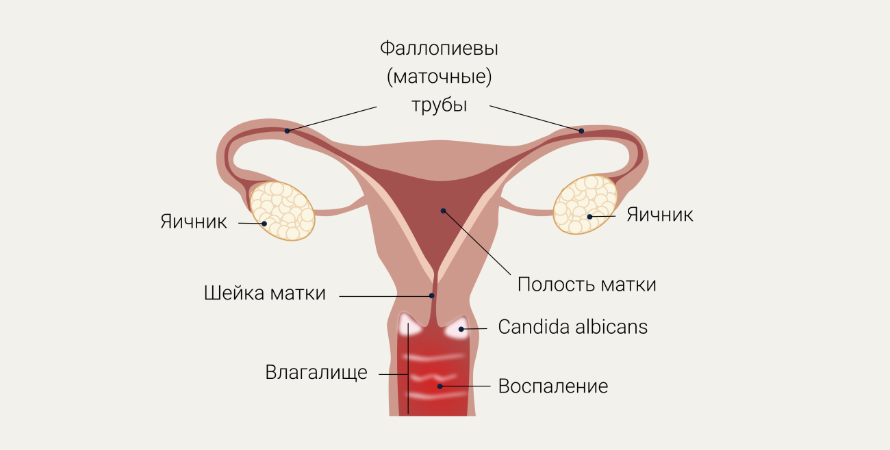 Эффективные методы лечения кандидозного вульвовагинита: советы и рекомендации специалистов