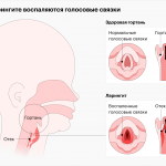 Эффективные методы лечения ларингита у детей: что нужно знать родителям