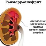 Гломерулопатии: причины, симптомы и современные методы лечения