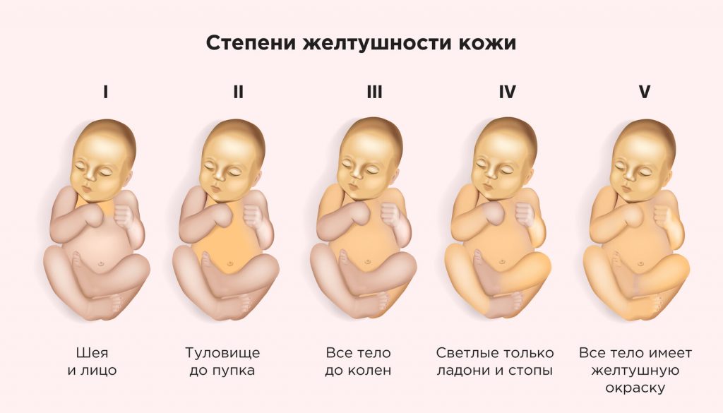 Как долго проходит желтушка у новорожденных: что нужно знать родителям