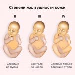 Как долго проходит желтушка у новорожденных: что нужно знать родителям