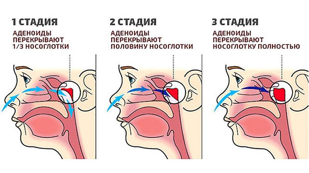 Как распознать и лечить аденоиды у детей: советы для родителей