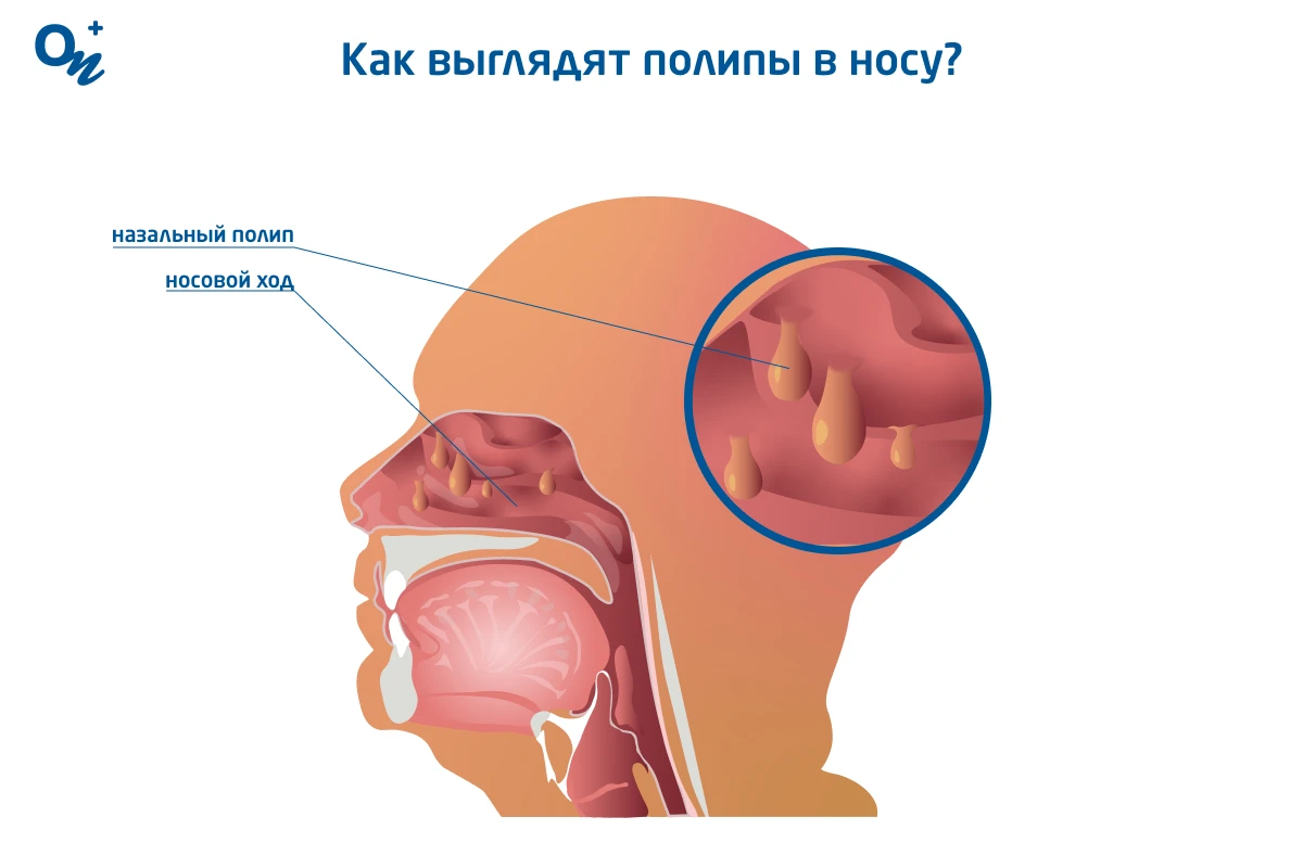 Как распознать и лечить полипы в носу у ребенка: советы для родителей