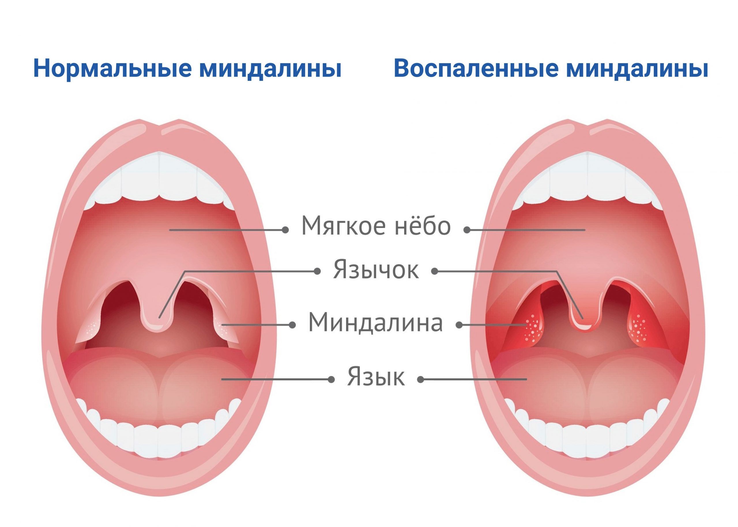 Как распознать и лечить рыхлые миндалины у ребенка: советы для родителей