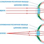 Как распознать и лечить спазм аккомодации: советы и рекомендации специалистов