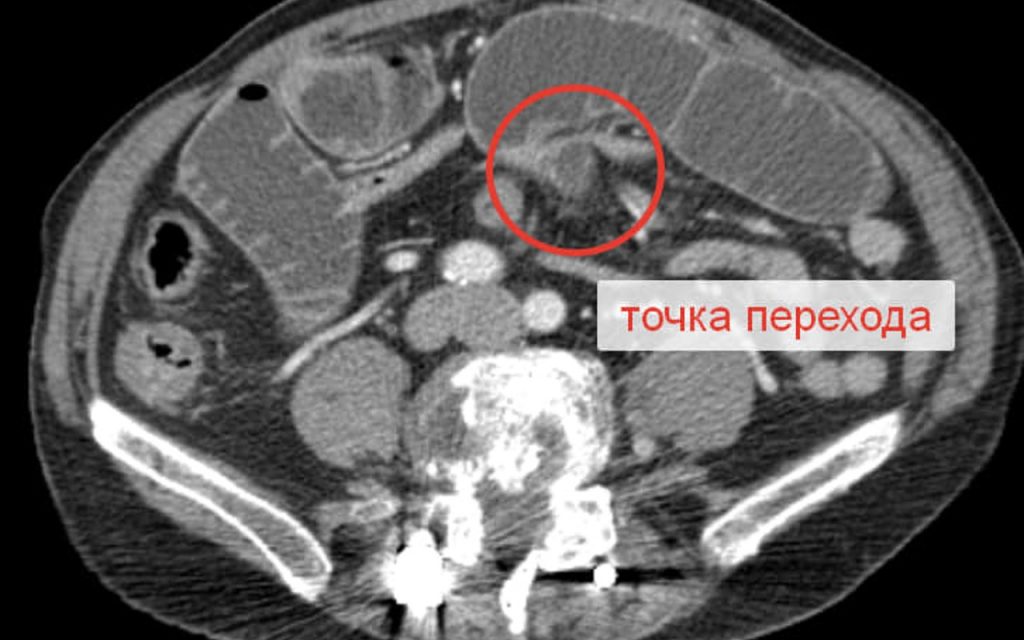 Кишечная непроходимость у детей: клинические рекомендации по диагностике и лечению