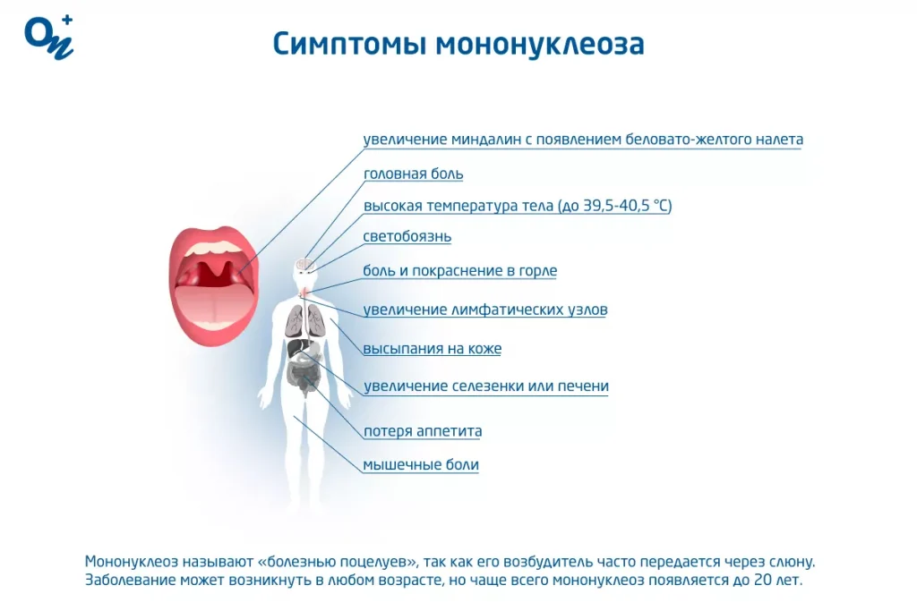 Мононуклеоз у детей: симптомы, лечение и профилактика