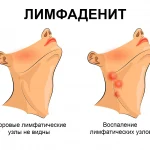 Острый лимфаденит у детей: причины, симптомы и лечение