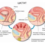 Острый цистит у детей: причины, симптомы и методы лечения