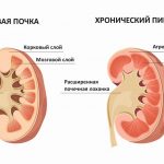 Пиелонефрит у детей: симптомы, диагностика и методы лечения