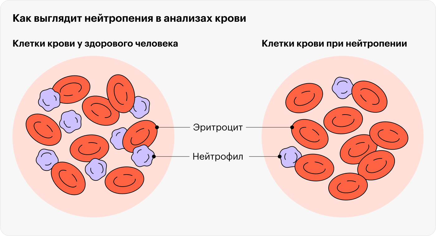 Причины и симптомы нейтропении у детей: что нужно знать родителям