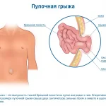 Пупочная грыжа у детей 6 лет: причины, симптомы и методы лечения