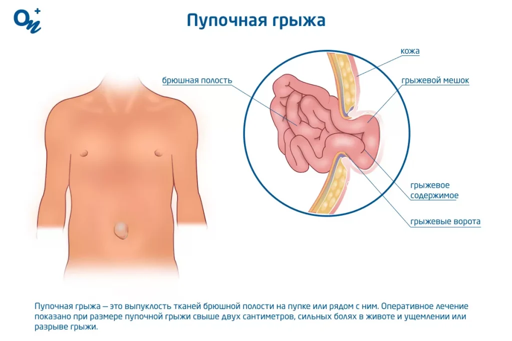 Пупочная грыжа у детей: причины, симптомы и методы лечения