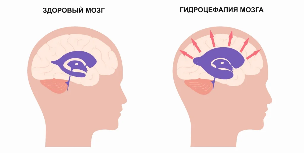 Расширение желудочков головного мозга у детей до года: причины, последствия и методы диагностики