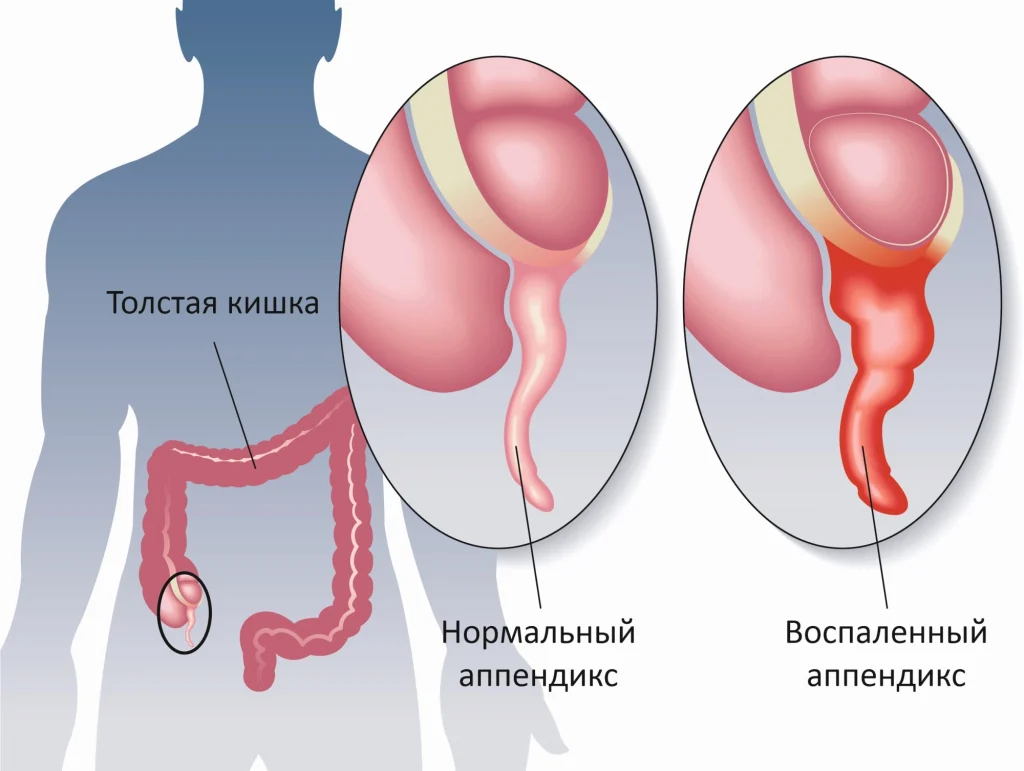 Симптомы аппендицита у подростков: как распознать опасное состояние вовремя