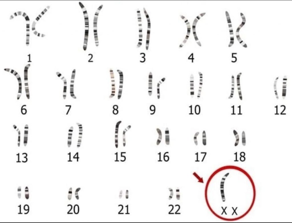 Синдром Шерешевского-Тернера: Кариотип и его влияние на здоровье женщин
