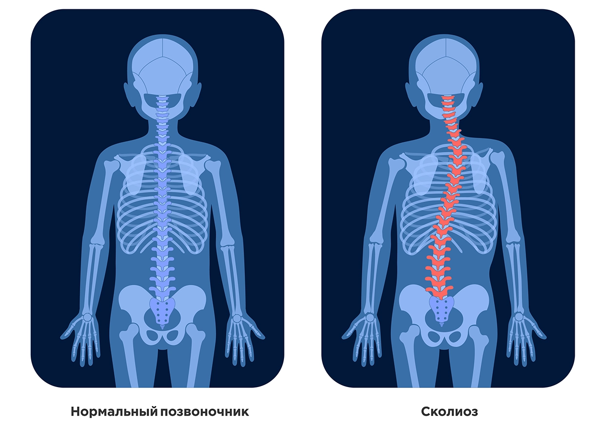 Сколиоз 2 степени у ребенка: причины, симптомы и методы лечения