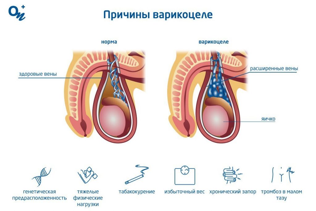 Варикоцеле у подростка: причины, последствия и важность своевременной диагностики