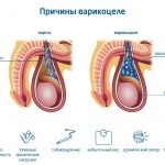 Варикоцеле у подростка: причины, последствия и важность своевременной диагностики