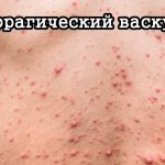 Васкулит у детей: симптомы, диагностика и методы лечения