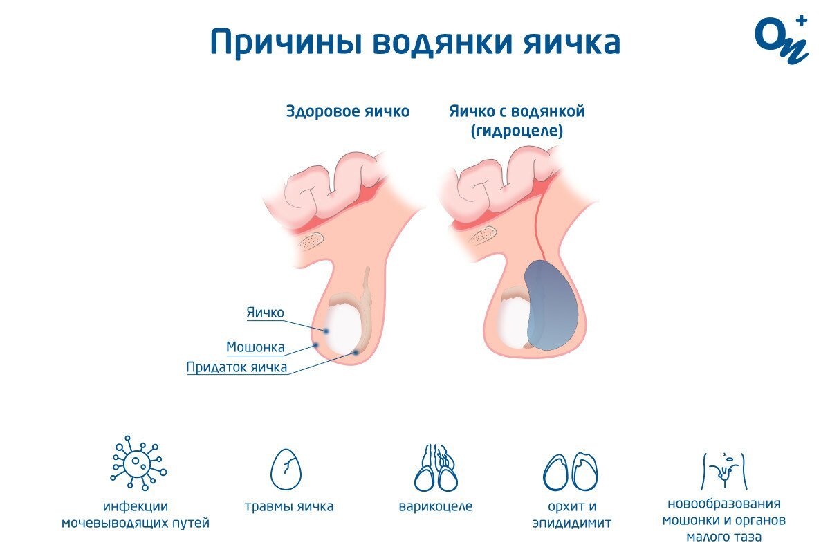 Водянка яичка у детей: причины, симптомы и методы лечения