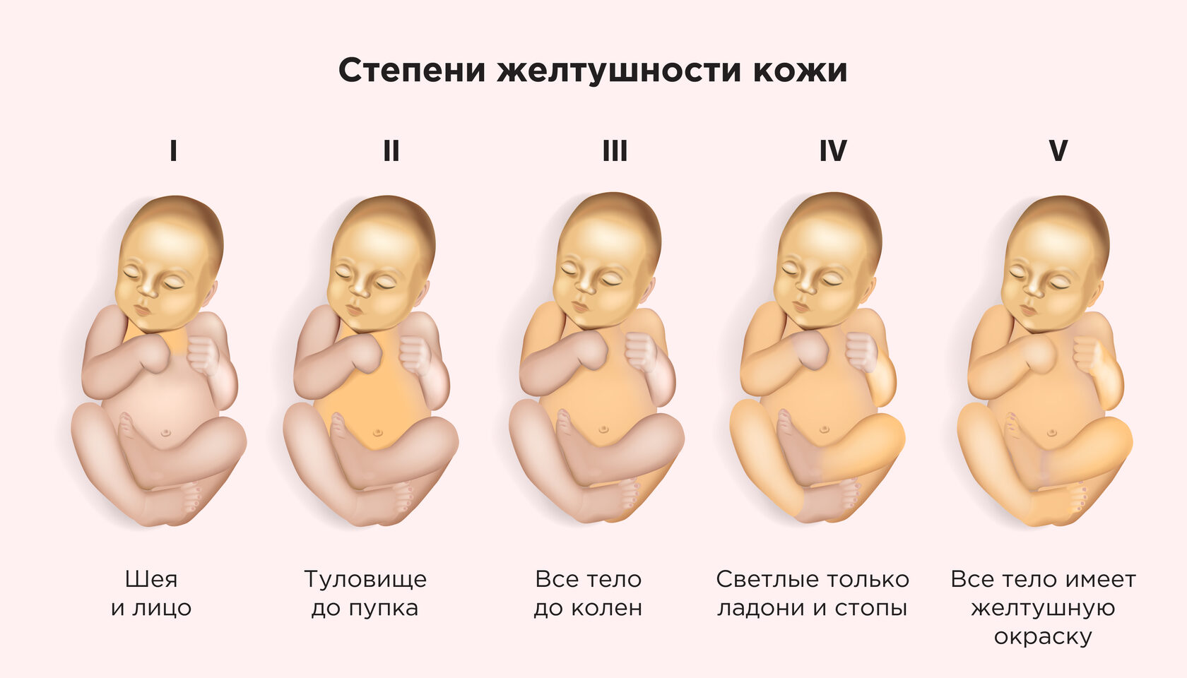 Желтушка у новорожденных: причины, симптомы и методы лечения